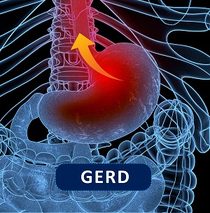 Gastroesophageal reflux disease - Atlanta Institute for ENT